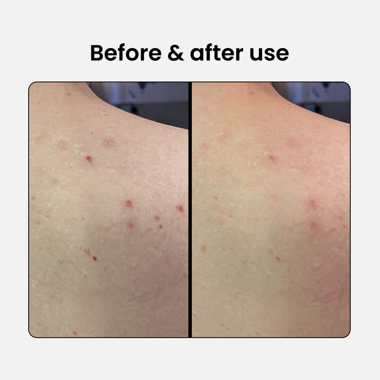 Spray corporal exfoliante con 2% BHA