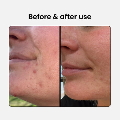 Set BHA: Limpiador + Suero